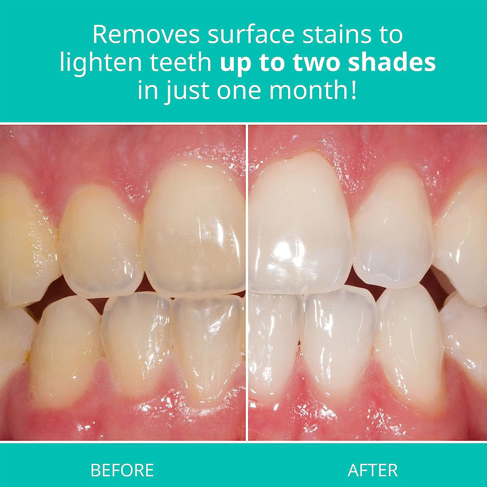 Opalescence Whitening Toothpas - Teeth Whitening Gel Opalescence 리뷰 및 가격