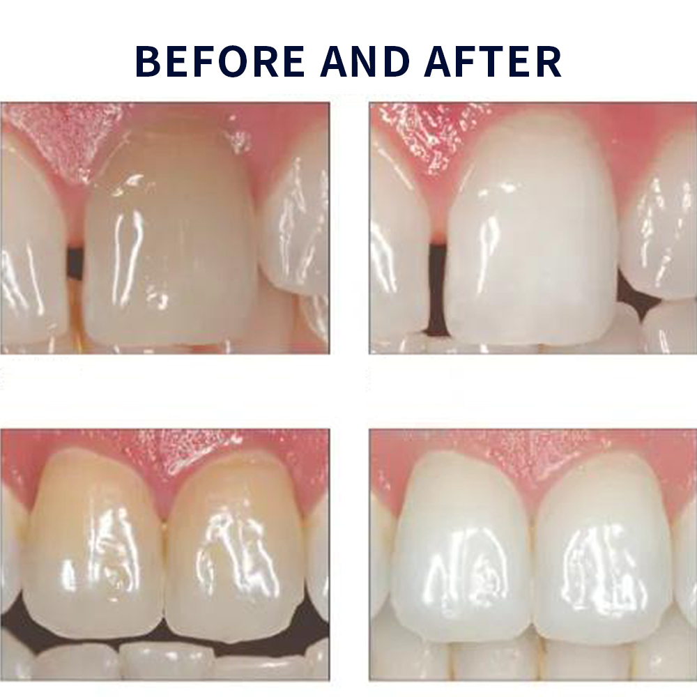 Opalescence Whitening 20% PF 2 - Teeth Whitening Home Kit 리뷰 및 가격