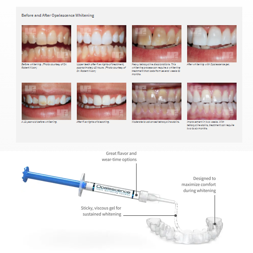 Opalescence Whitening 20% PF 2 - Teeth Whitening Home Kit 리뷰 및 가격