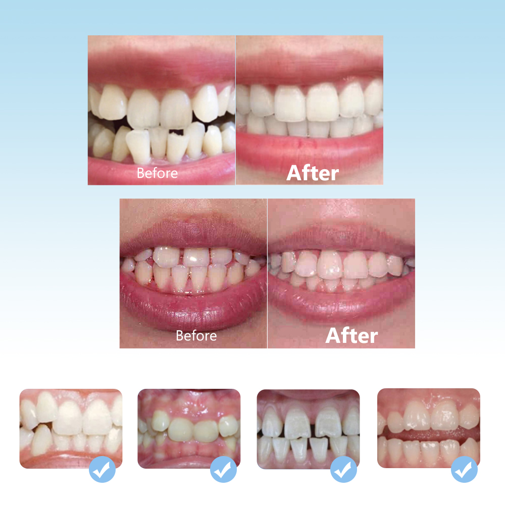 Dental Orthodontic Braces Set  - Teeth Whitening Mouth Guard 리뷰 및 가격