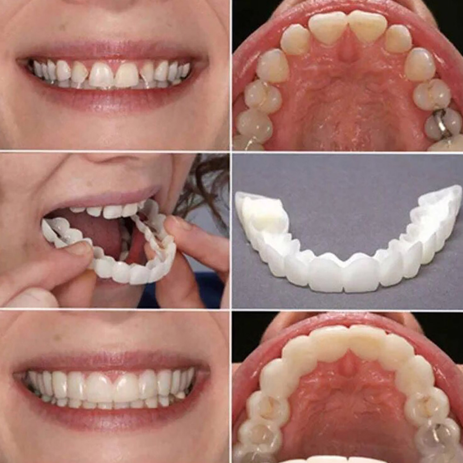 Daily Commute Teeth Veneers, T - Teeth Whitening In Office 리뷰 및 가격