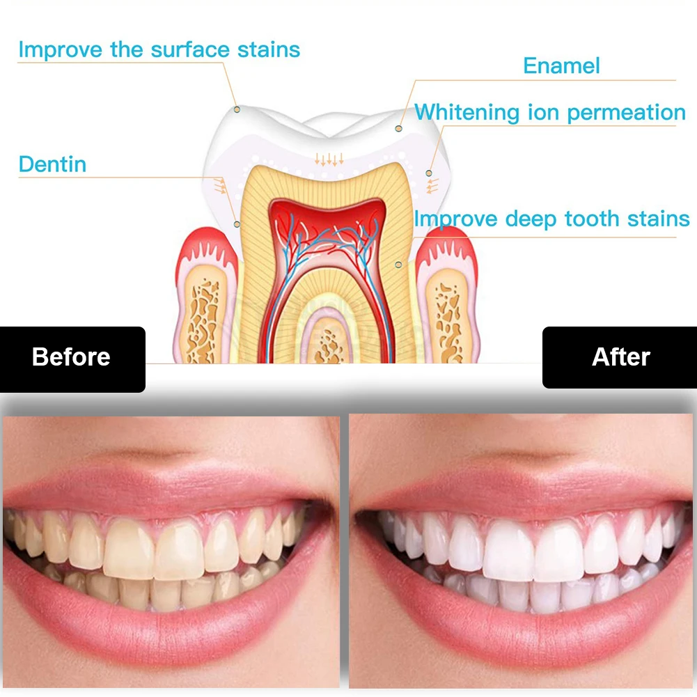 Dental Teeth Whitening Kit Min - Teeth Whitening Remedies 리뷰 및 가격