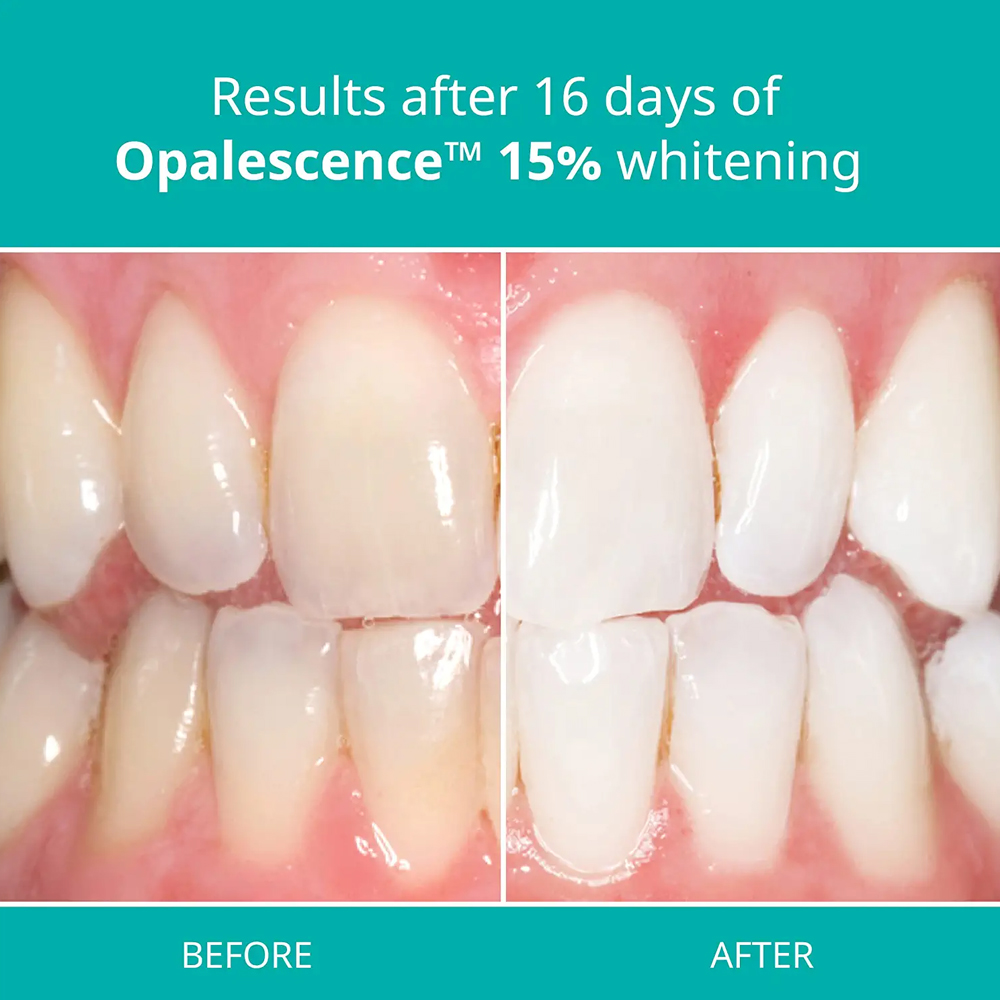 opalescence pf 15% refill kit  - Teeth Whitening Gel Opalescence 리뷰 및 가격