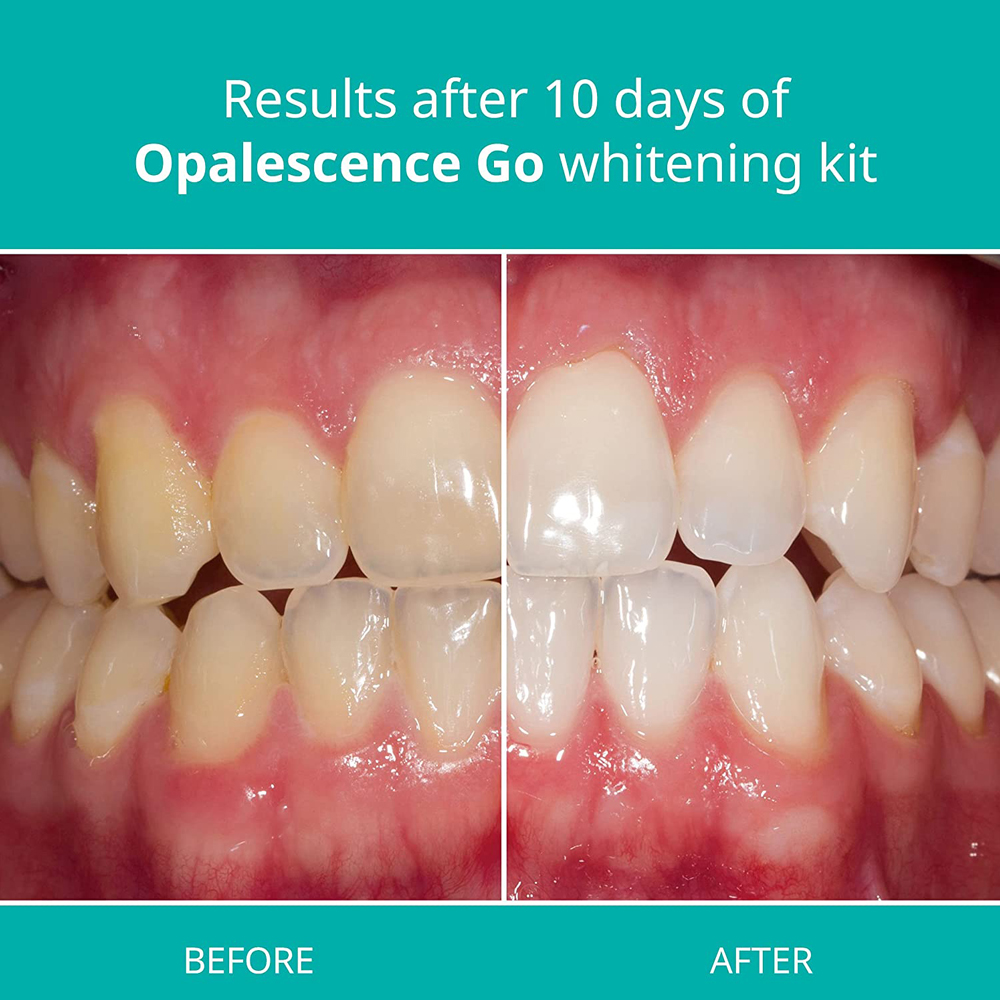 Opalescence Go Teeth Whitening - Teeth Whitening Home Kit 리뷰 및 가격