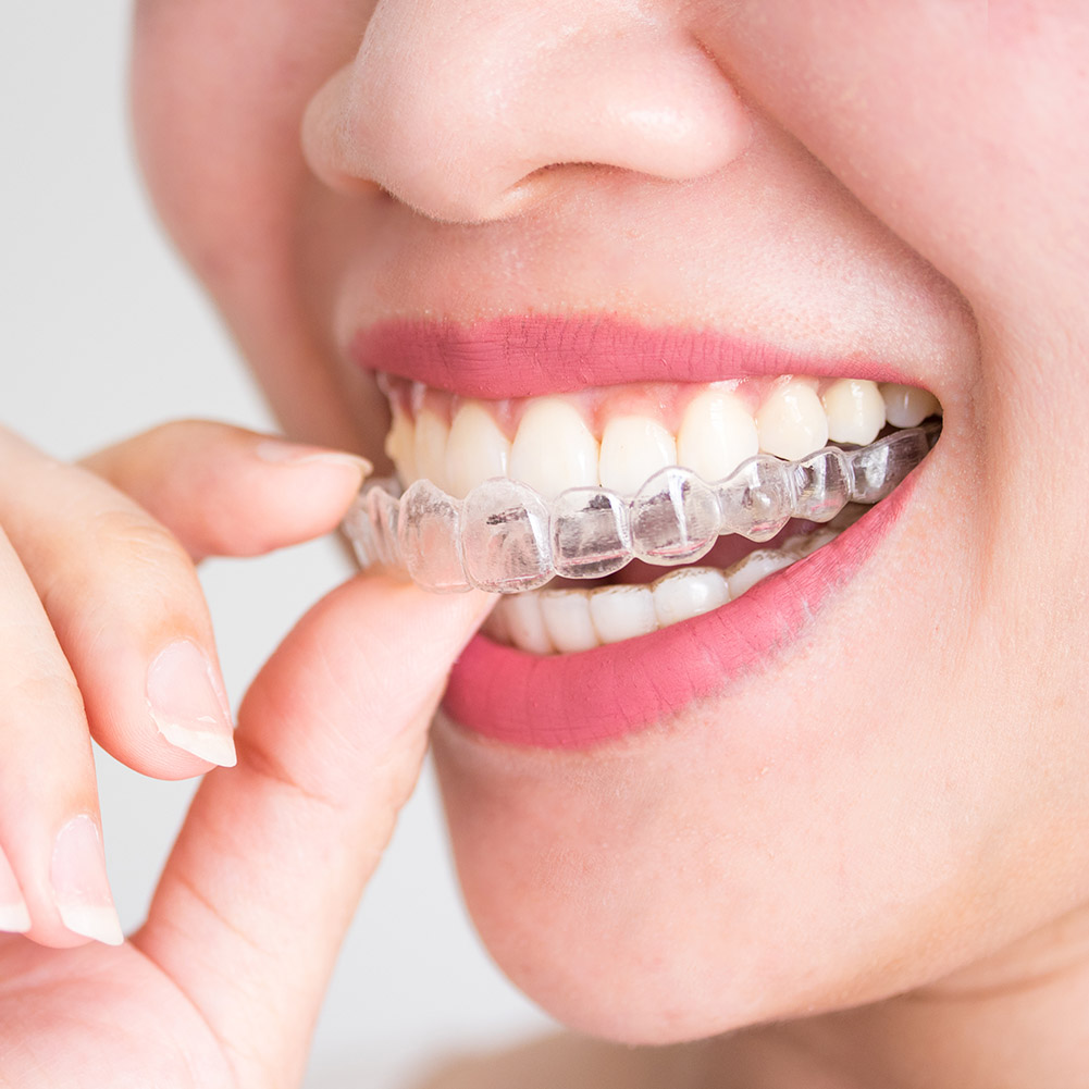 2/4pcs Mouth Guard Teeth Prote - Teeth Whitening Mouth Guard 리뷰 및 가격